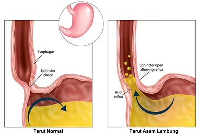 Asam lambung